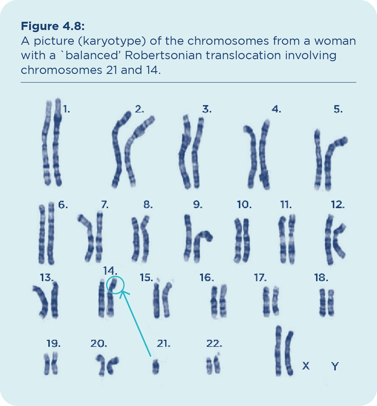 What is a karyotype? Why is it important to know a person's karyotype  before determining the cause of any chromosome abnormalities? - Quora